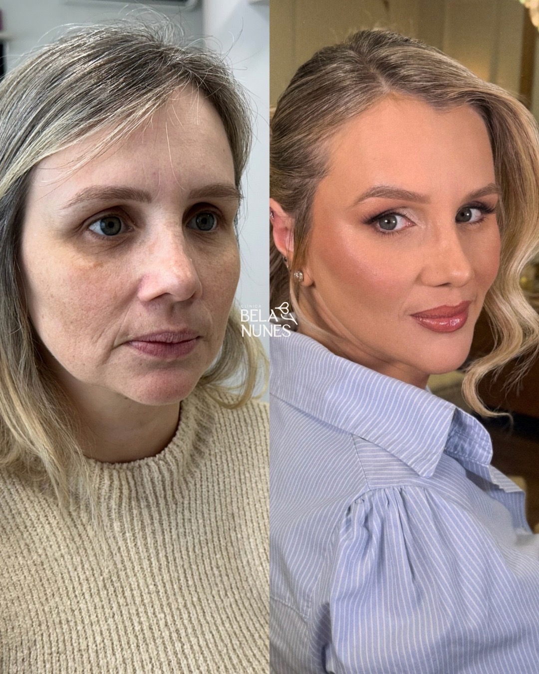 Resultado 11: antes e depois