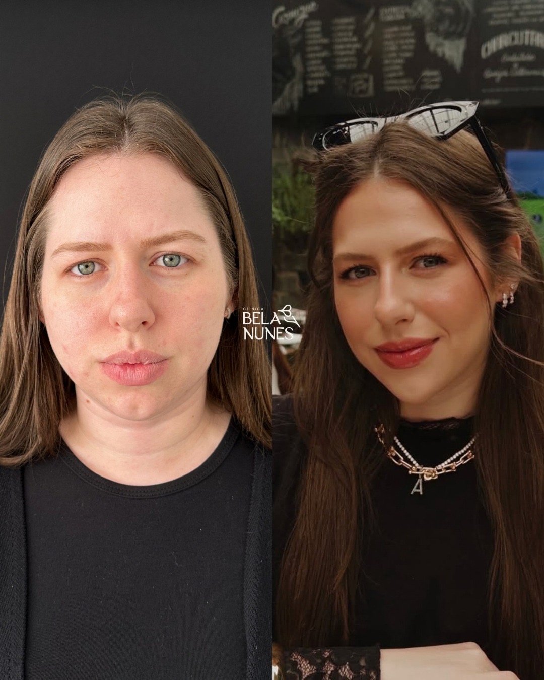 Resultado 13: antes e depois