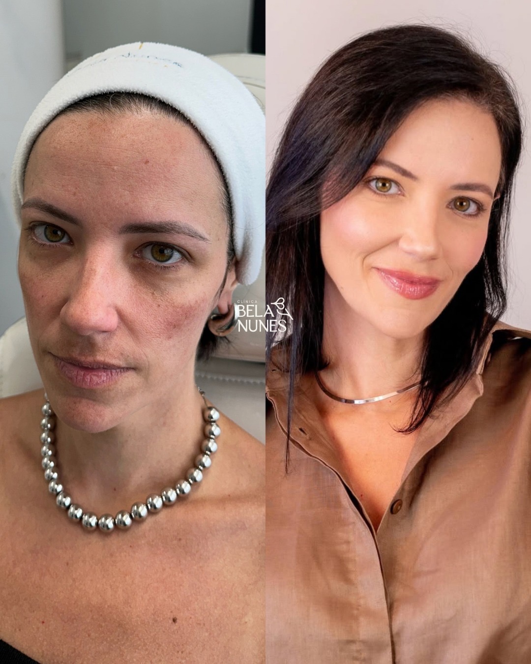 Resultado 14: antes e depois