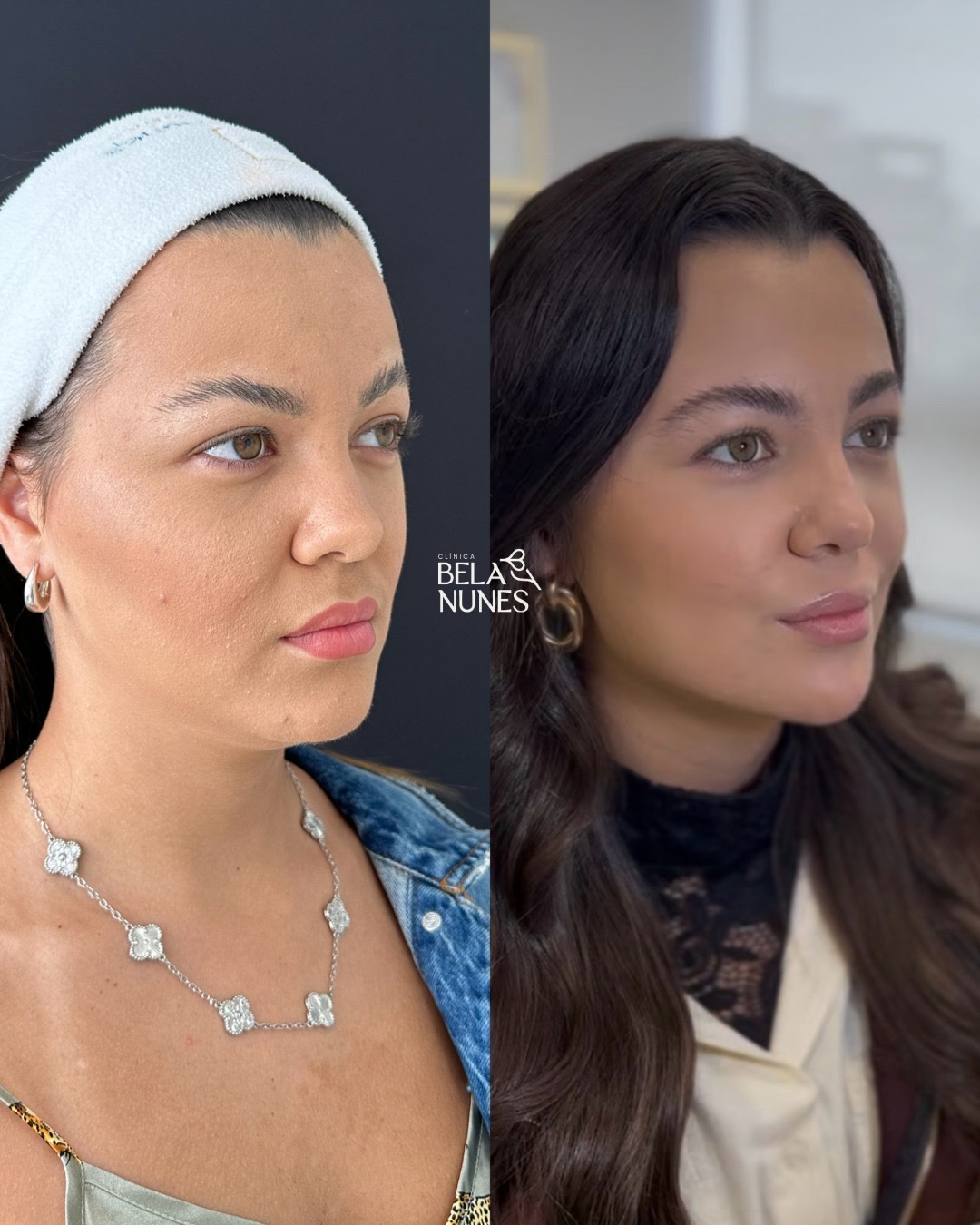 Resultado 16: antes e depois