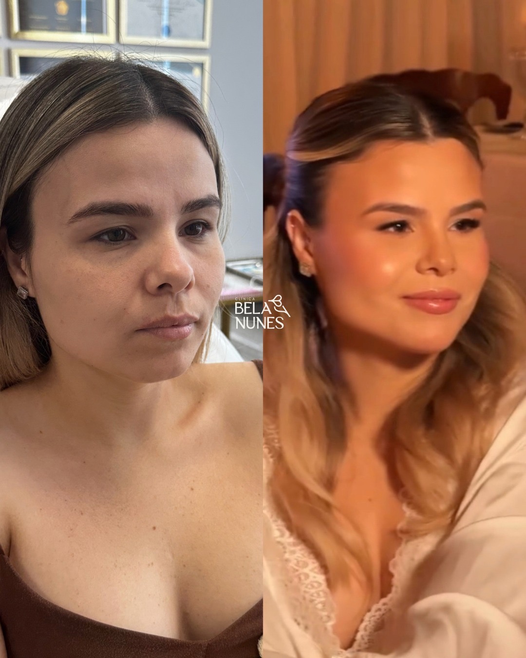 Resultado 17: antes e depois