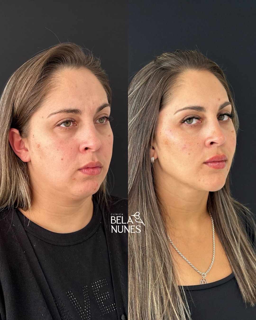 Resultado 21: antes e depois