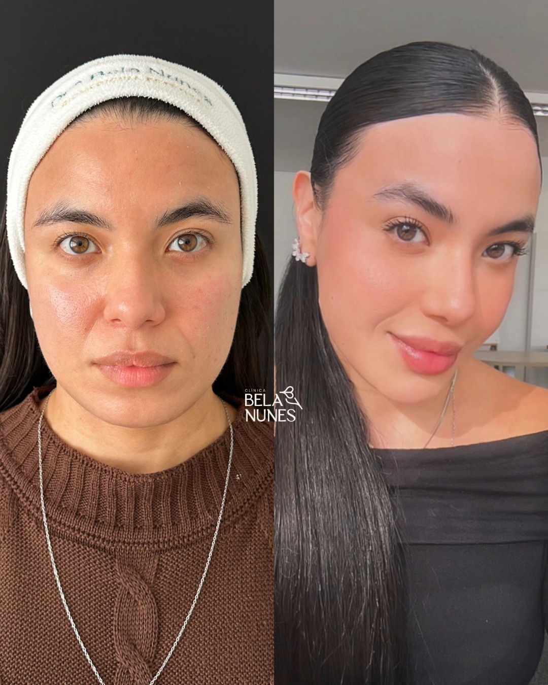 Resultado 22: antes e depois