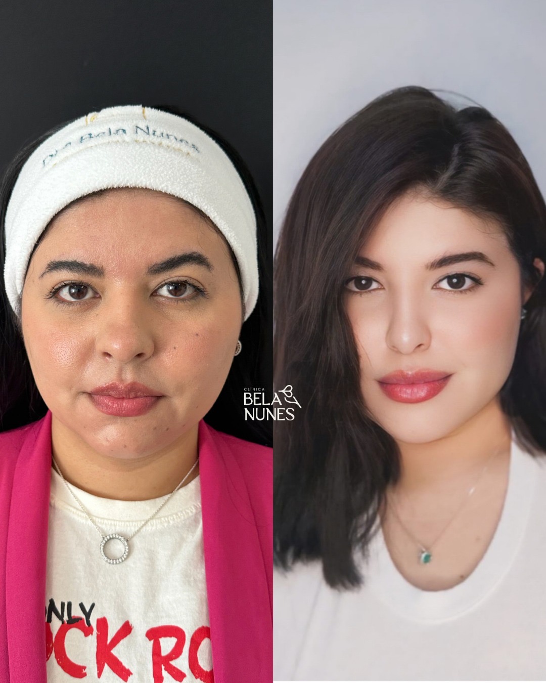 Resultado 23: antes e depois