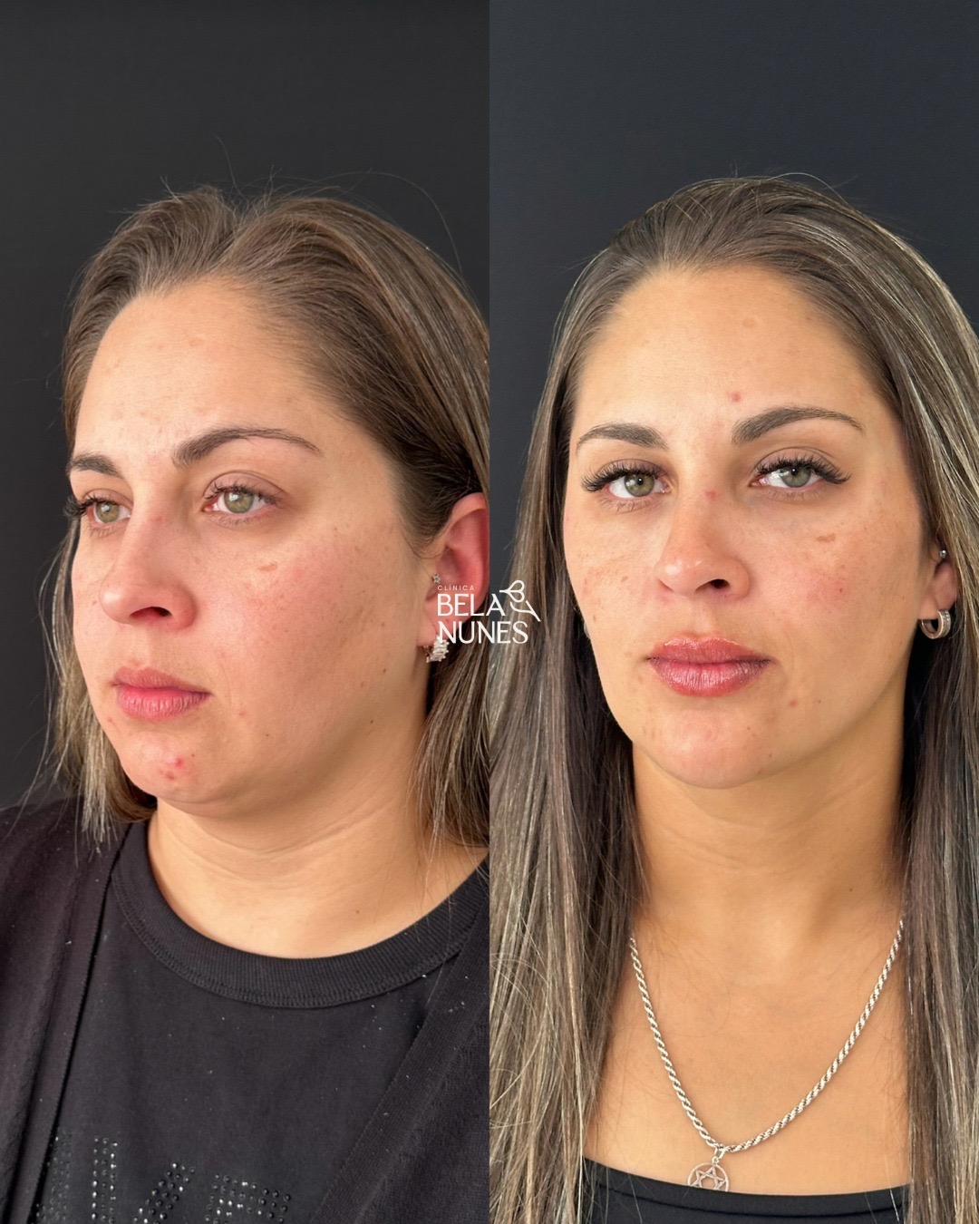 Resultado 25: antes e depois