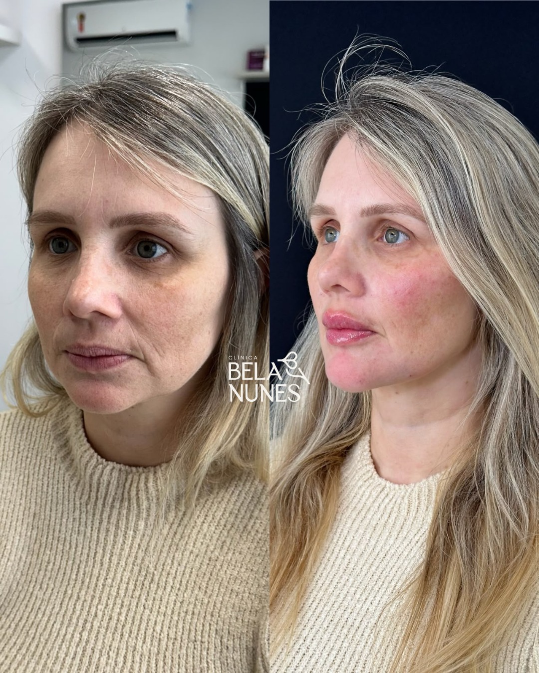 Resultado 26: antes e depois