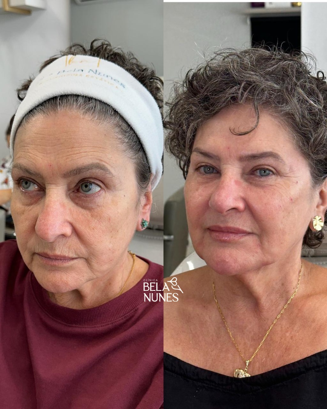 Resultado 27: antes e depois