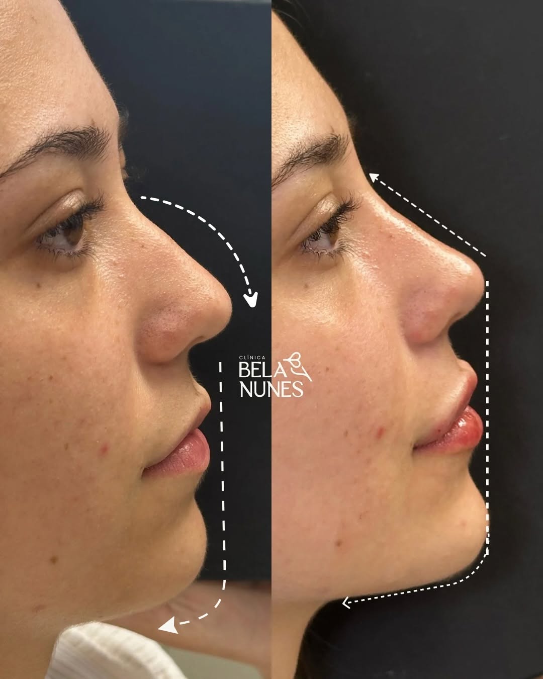 Resultado 31: antes e depois