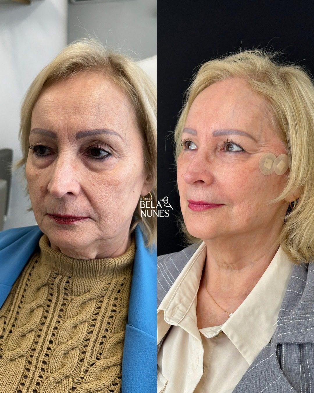 Resultado 5: antes e depois
