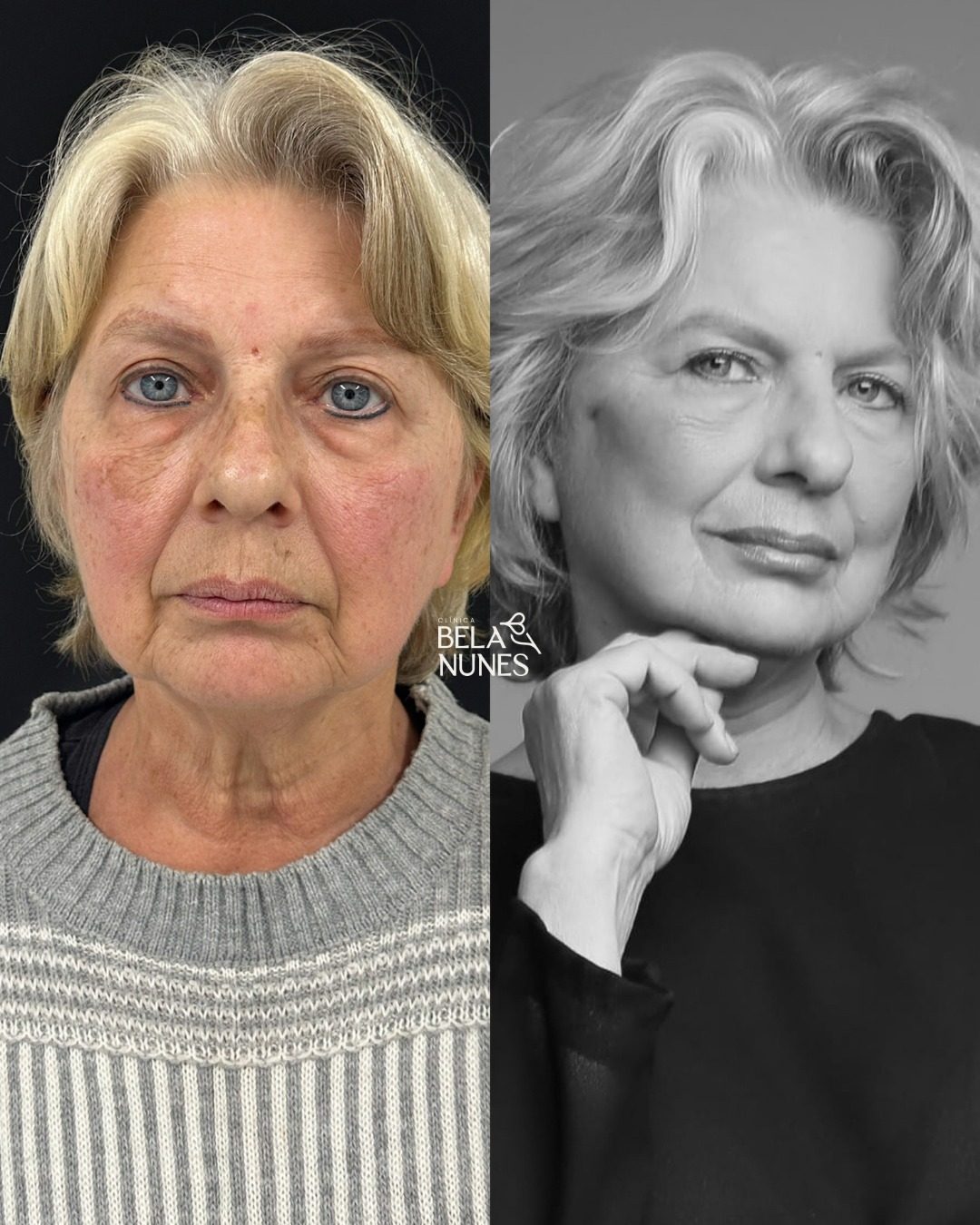 Resultado 6: antes e depois