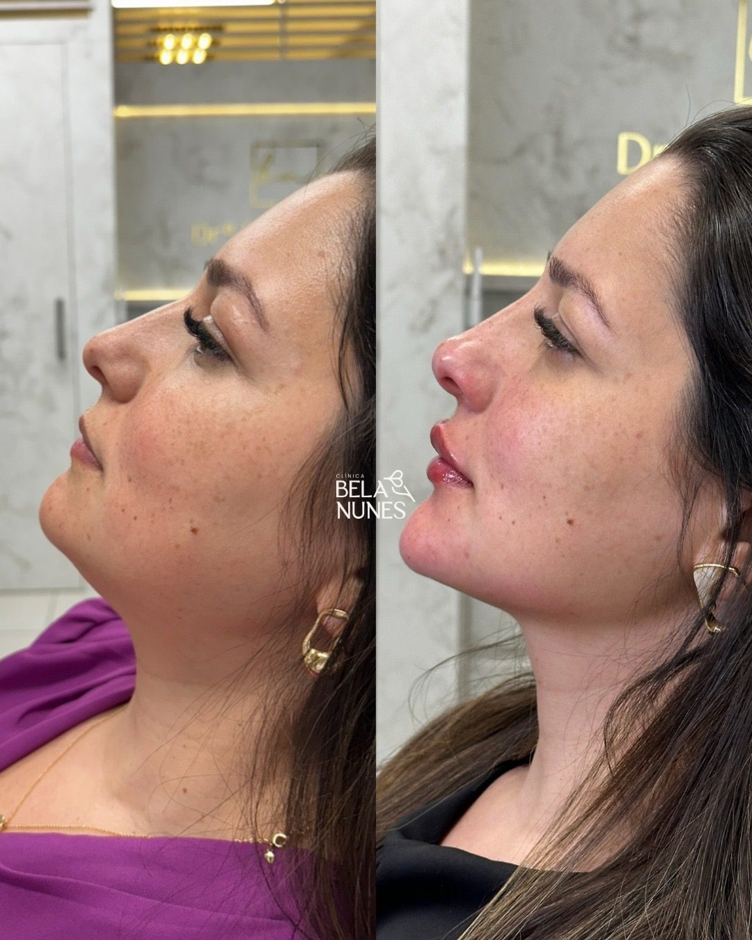 Resultado 1: antes e depois